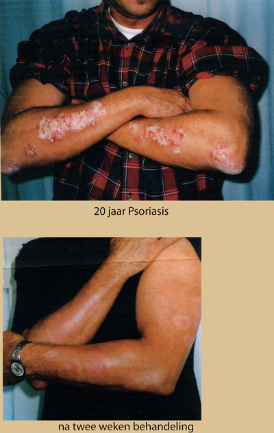 Resultaten behaald bij iemand die al 20 jaar Psoriasis had